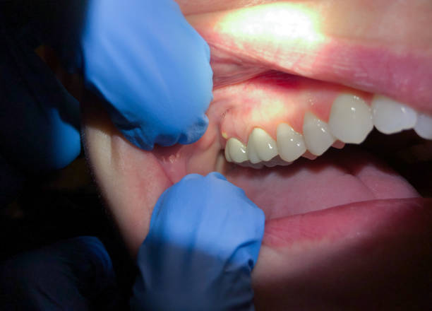 Best Emergency Wisdom Teeth Removal in Rossville, GA